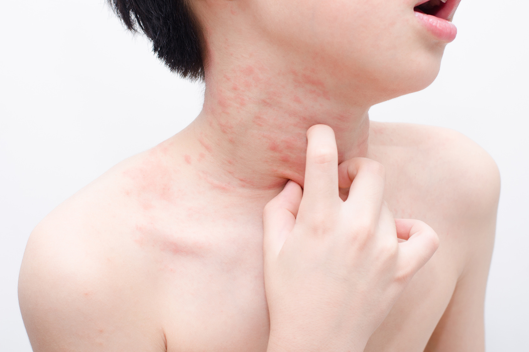 Common Skin Problems In Teenagers