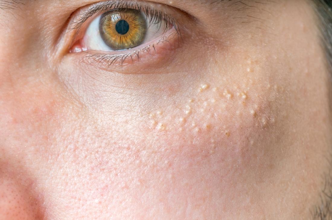 Facts About White Spots