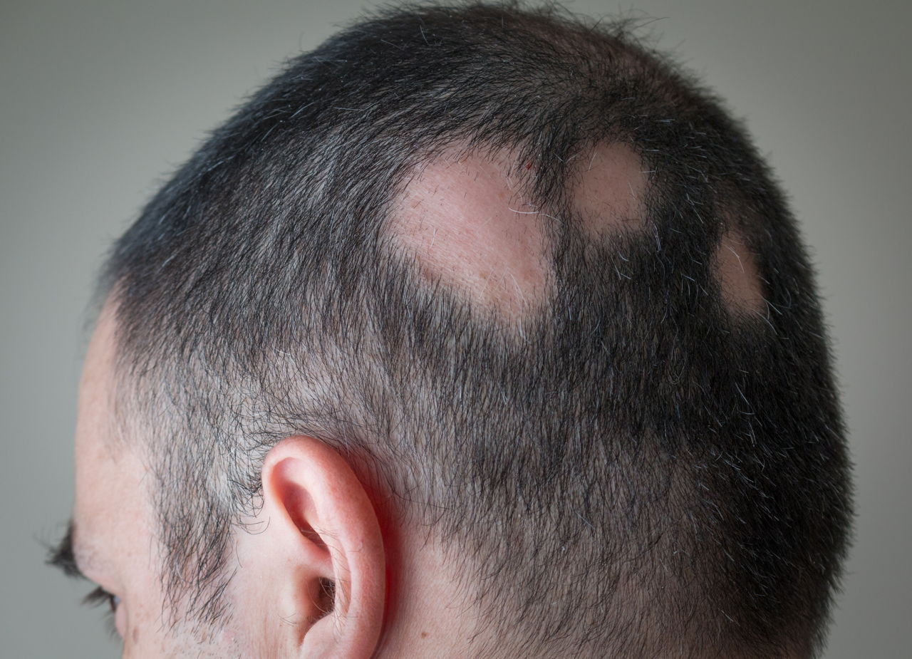 Stem Cell Hair Growth Therapy For Alopecia - Parisa Skin Cosmetic and Laser  Center