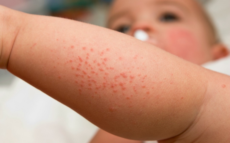 Common Skin Problems In Children