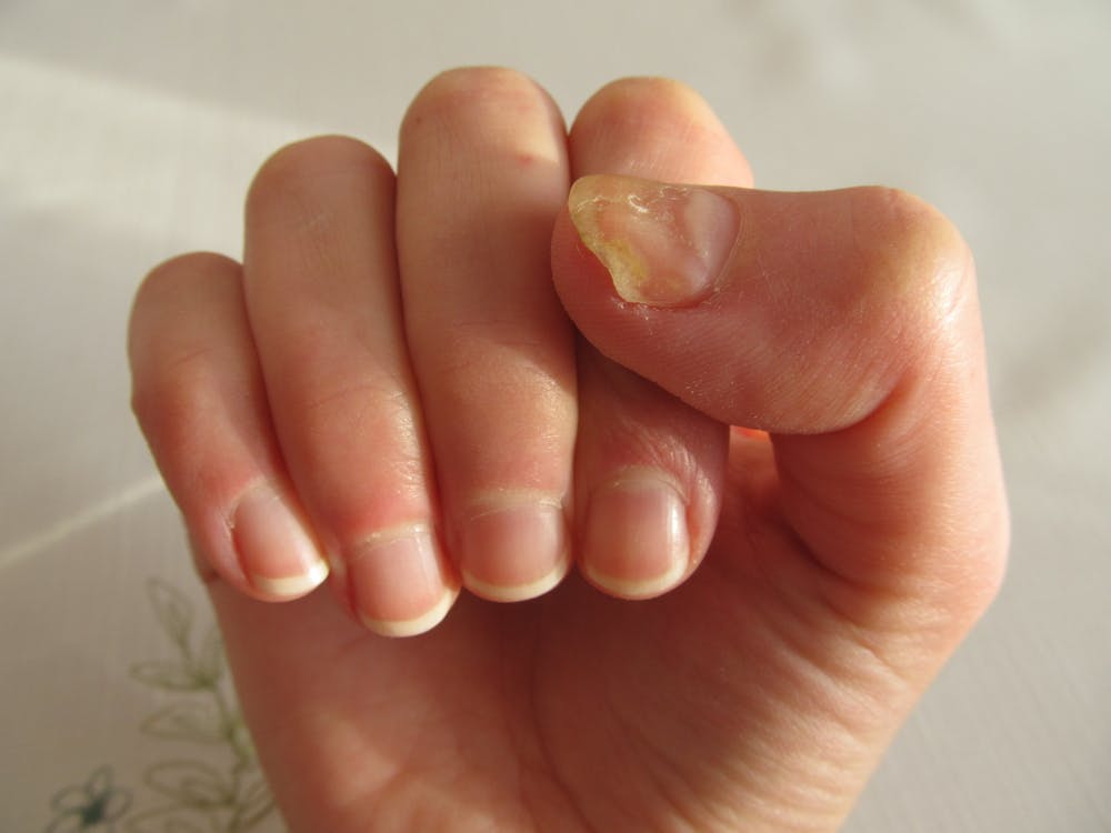 Nail Fungal Infections