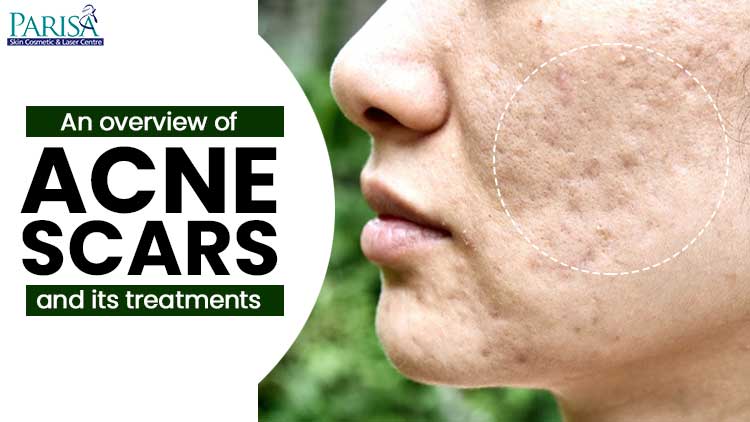 Overview Of Acne Scars Treatments