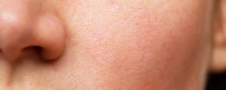 Effective Ways That Help Reduce Open Pores