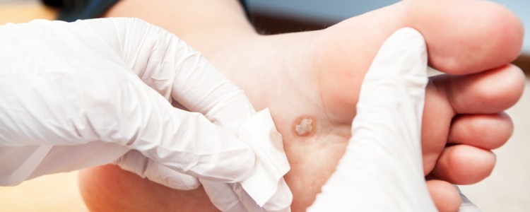 Warts Removal Treatment 