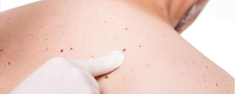 Skin Tags Treatment in Chandigarh