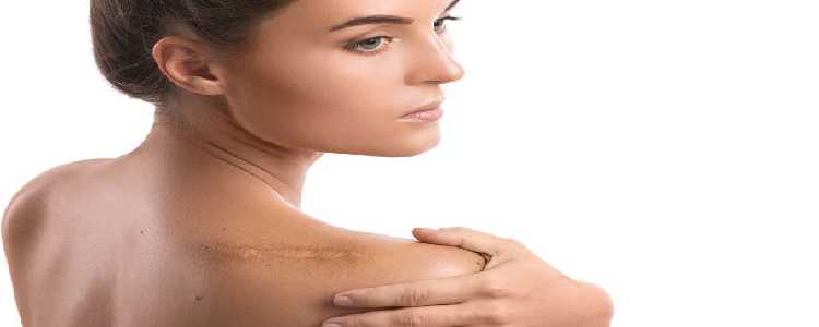 Keloids and Hypertrophic Scar Treatment 