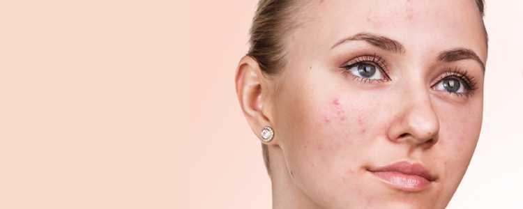 Acne Scars Removal Treatment