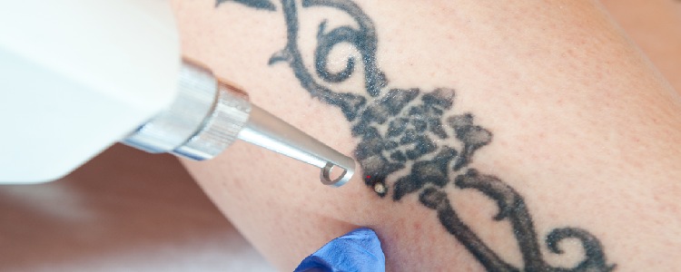 Tattoo Removal in Chandigarh | Permanent Laser Tattoo Removal Clinic, Cost  in Punjab