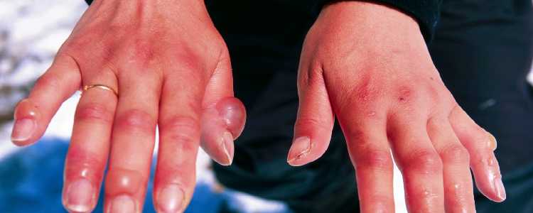 Best Chilblains Disease Treatment for Hands, Fingers, Toes and Ears in