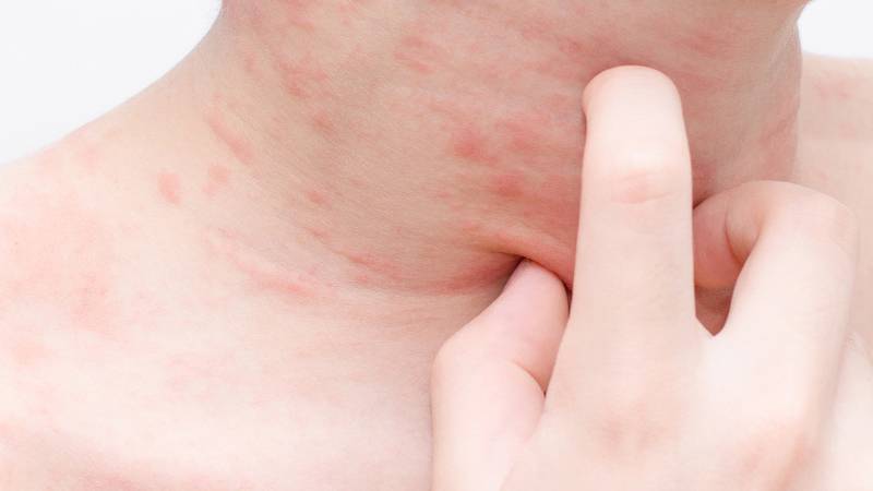 Common Skin Problems In Teenagers