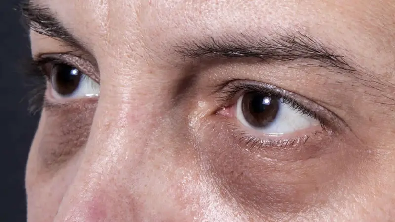 Dark Circles Under Eyes
