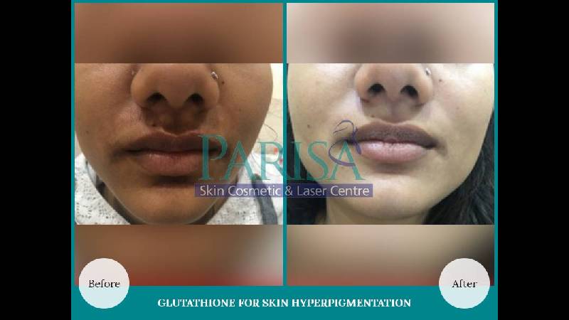 GLUTATHIONE-FOR-SKIN-HYPERPIGMENTATION.jpg