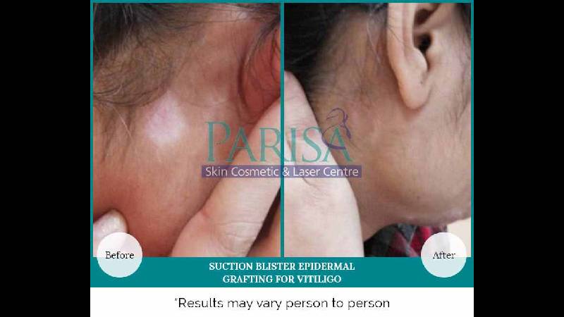 VITILIGO