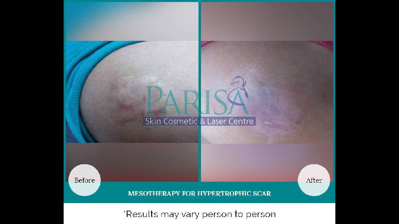 MESOTHERAPY FOR HYPERTROPHIC SCAR