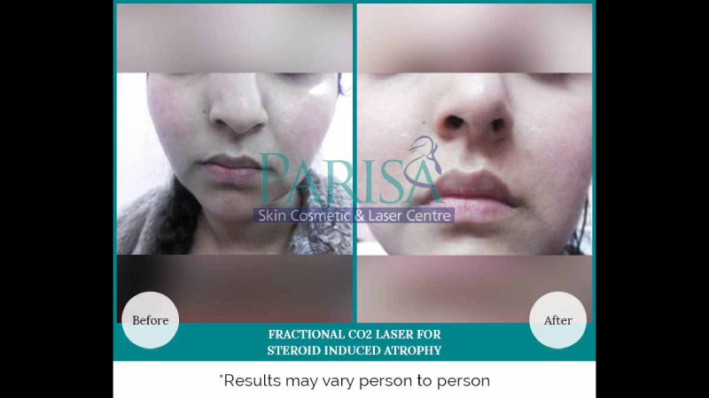 FRACTIONAL CO2 LASER