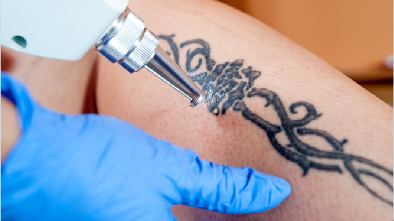 LASER TATTOO REMOVAL