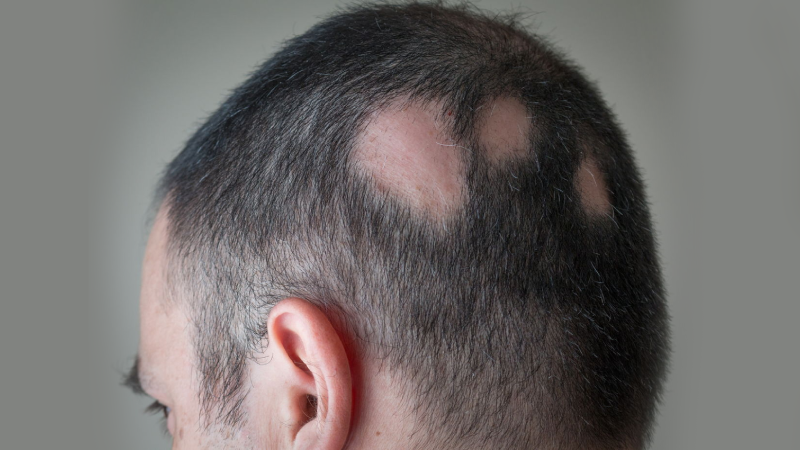Hair Growth Therapy