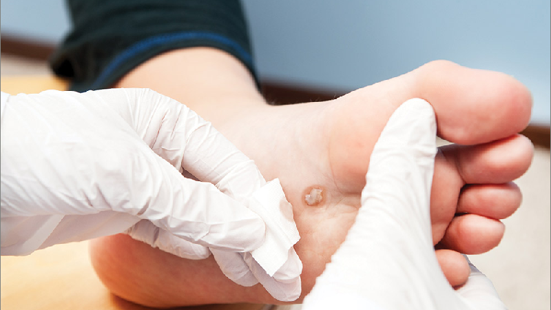Vaccine For Viral Anogenital Warts
