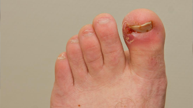 Ingrowing Toe Nail