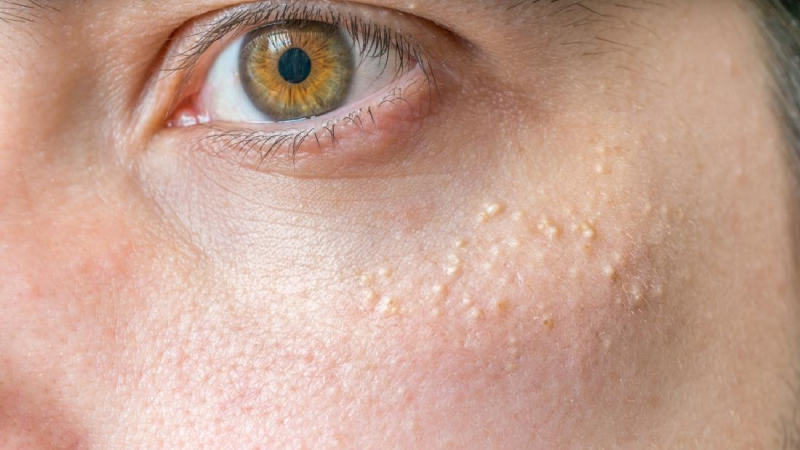 Facts About White Spots