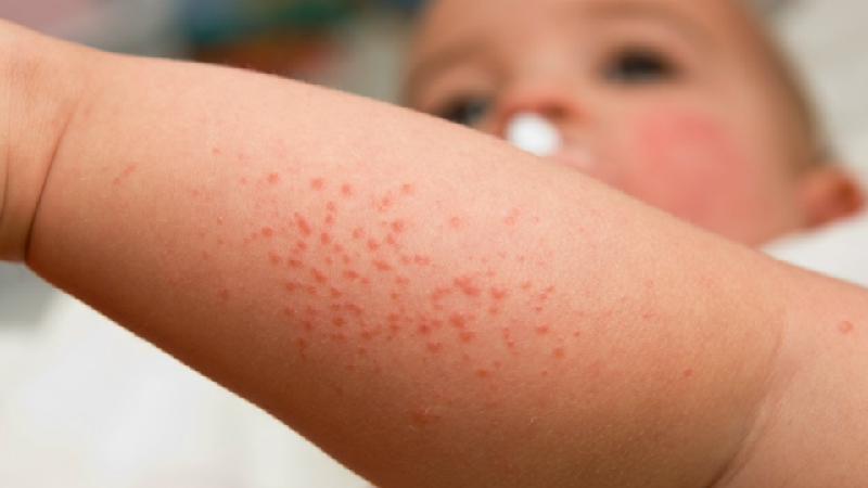 Common Skin Problems In Children
