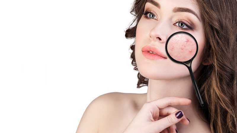 Pimples – Be Acne Free