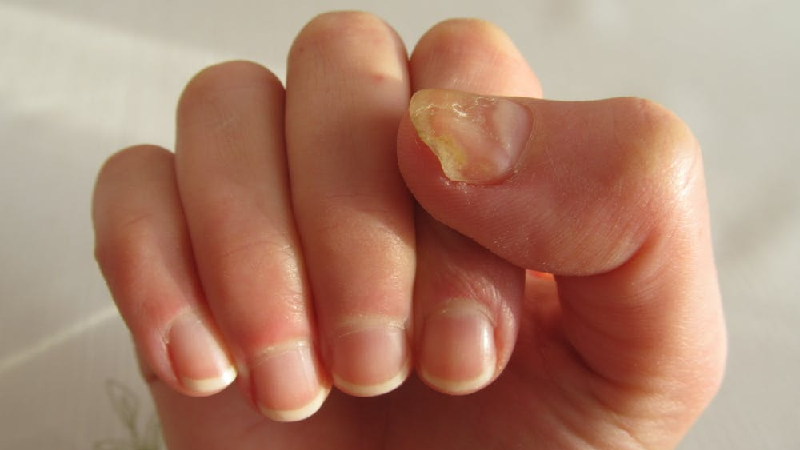 Nail Fungal Infections