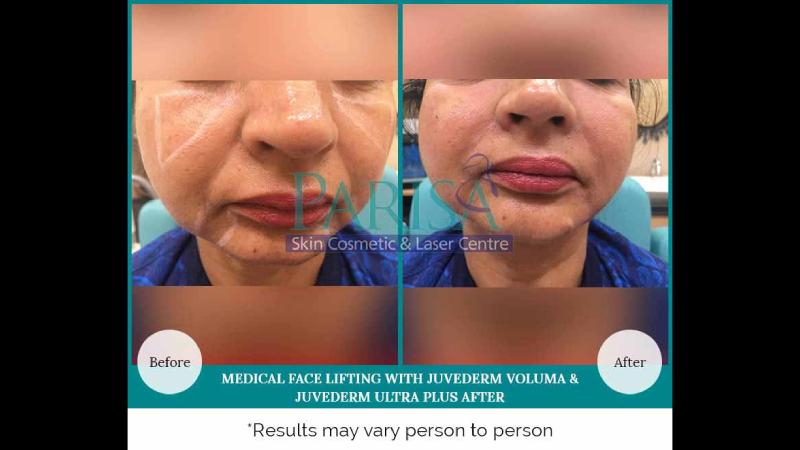 MEDICAL FACE LIFTING