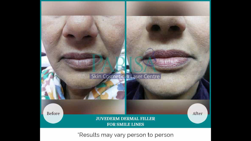 DERMAL FILLER FOR SMILE LINES