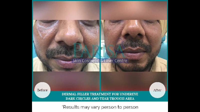 DERMAL FILLER