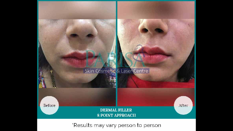 DERMAL FILLER