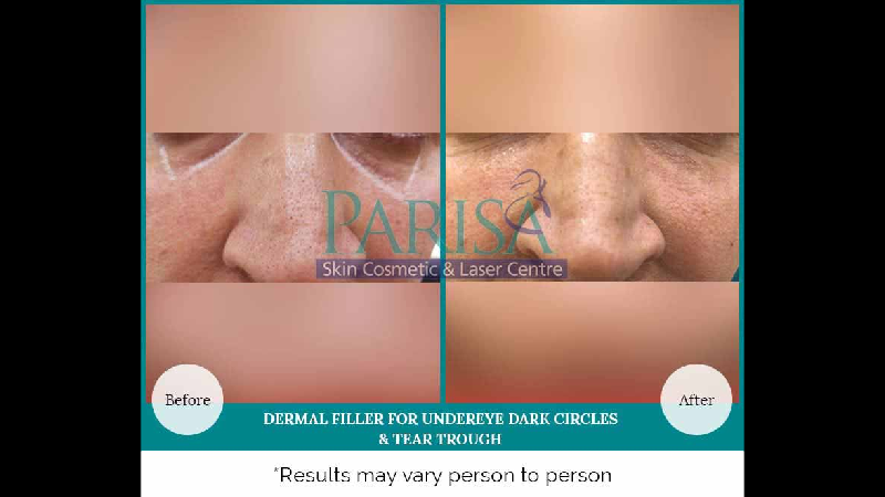 DERMAL FILLERS