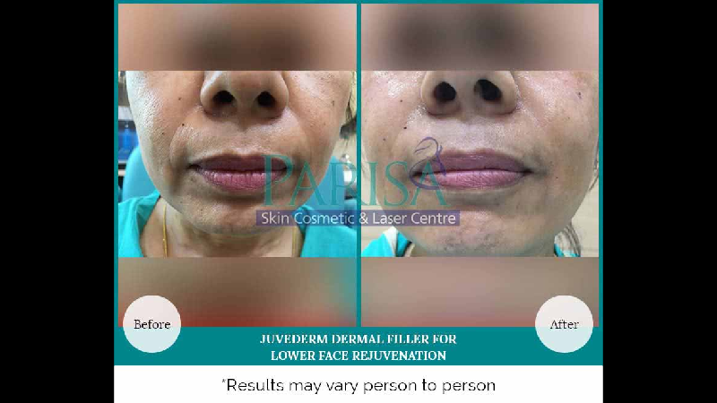 DERMAL FILLER