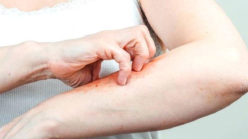 SKIN ALLERGY TO BLEACH