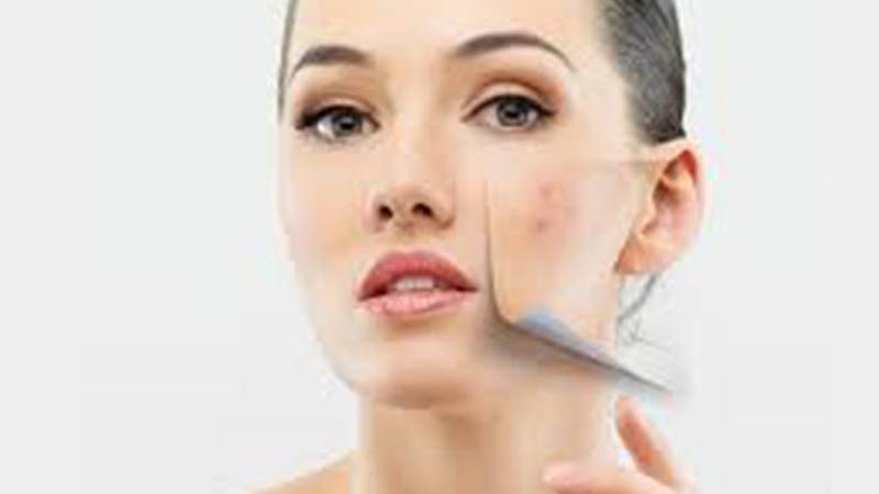 Acne Facts