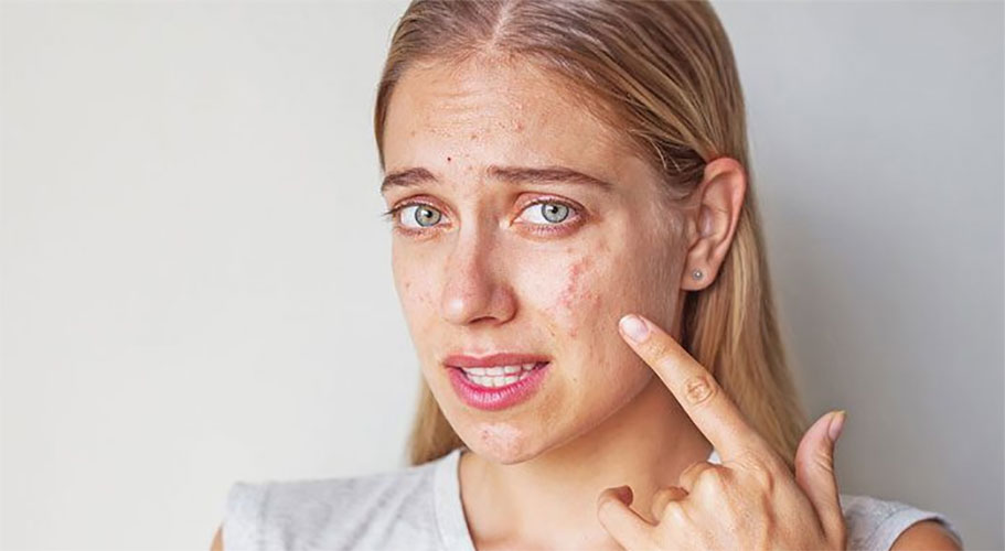 ACNE AFTER HAIR OILING