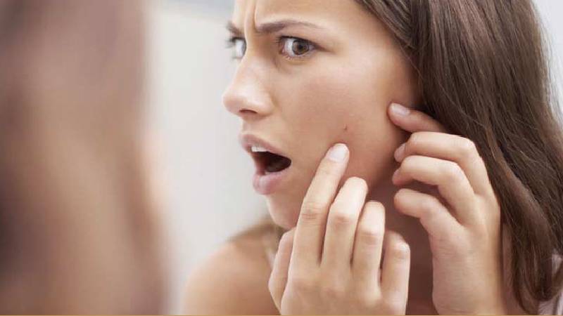 ACNE TREATMENT IN CHANDIGARH