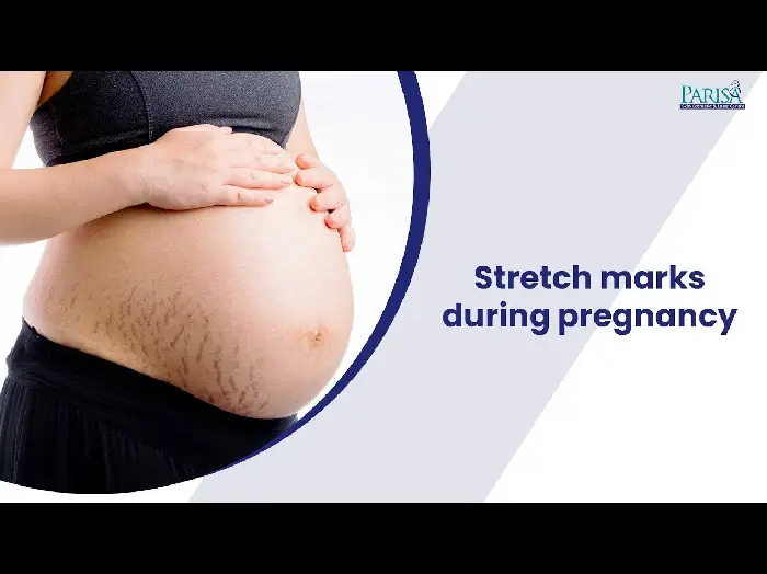 Stretch Marks During Pregnancy